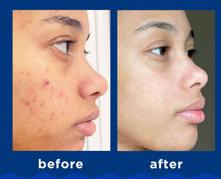 فوم شوینده ضد جوش پانوکسیل حجم 156 میل-فروشگاه آرایشی و بهداشتی آزارو در شیراز